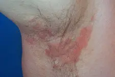 Koltuk Altı İltihabı Belirtileri ve Tedavisi